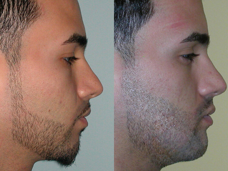 Before and After - Chin Augmentation