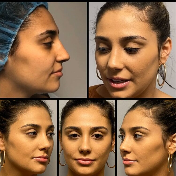 Before and After - Rhinoplasty Meta Landing