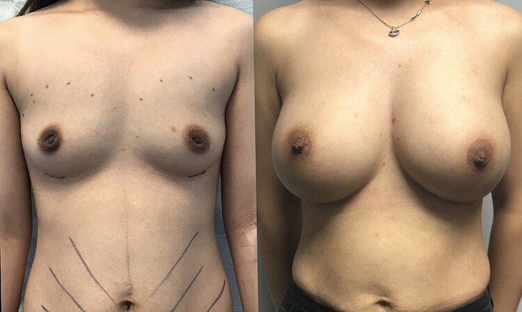 Before and After - Composite Implants and Fat