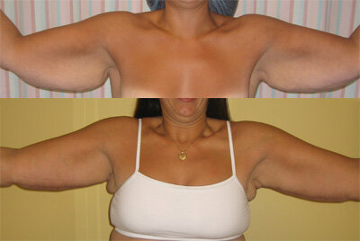 Before and After - Arm Lift