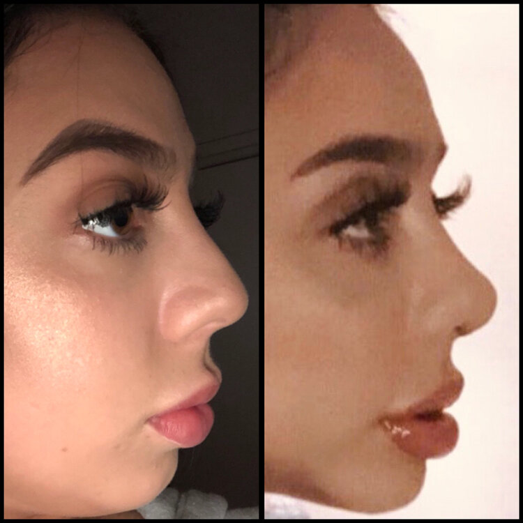 Before and After - Rhinoplasty Meta Landing