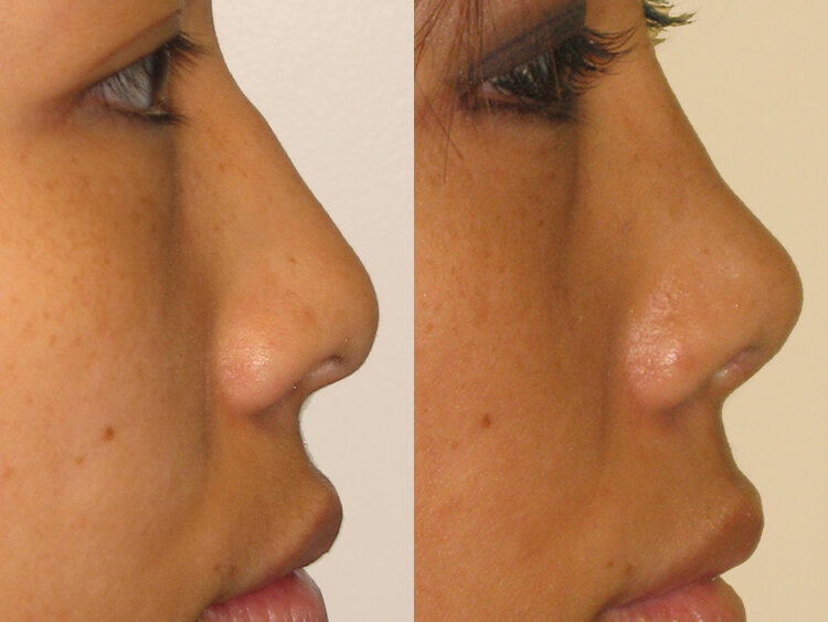 Before and After - Non-Caucasian Rhinoplasty