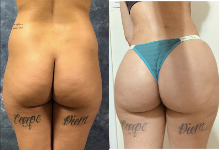 Before and After - Composite Butt Augmentation