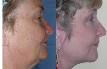 Neck lift before and after