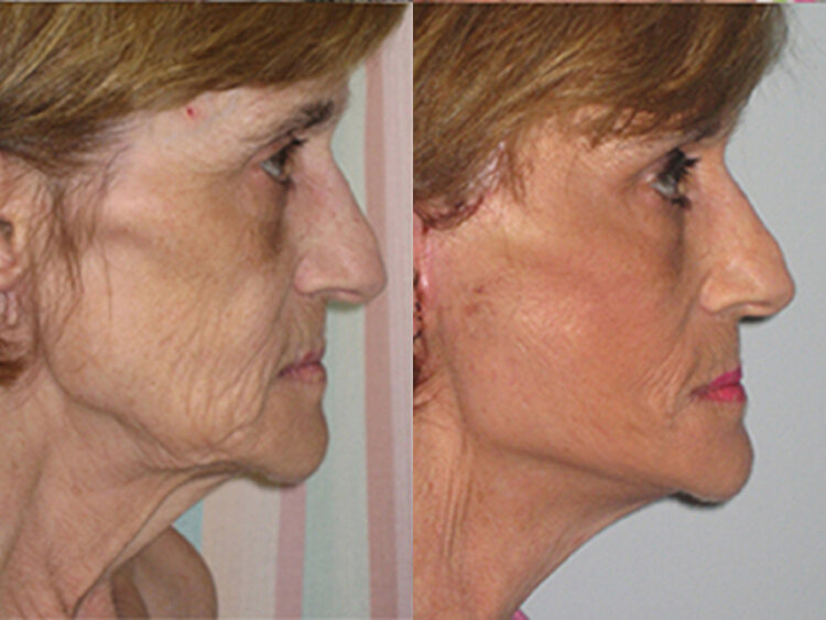 Before and After - Facelift