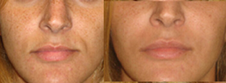 Before and After - Facial Fat Grafting